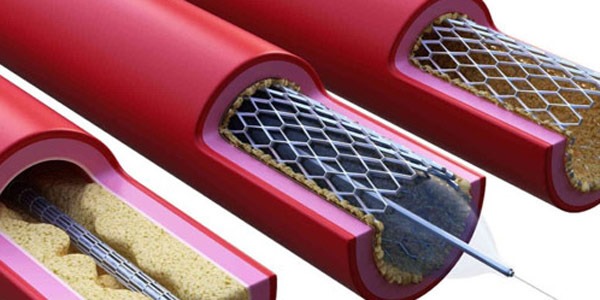 Stent Nedir ve Kimler İçin Uygundur