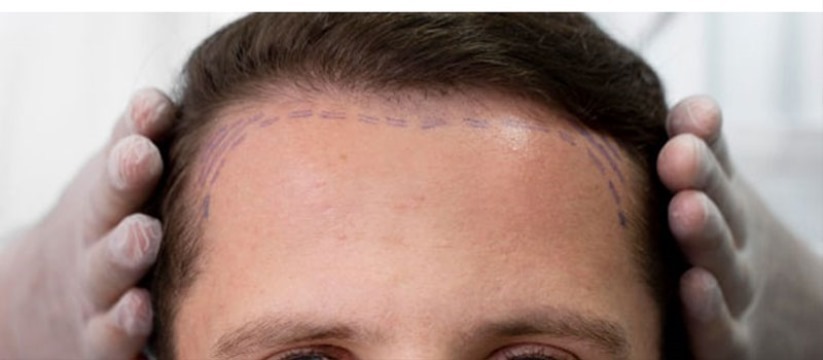 Antalyada Saç Estetiğine İlgi Artıyor