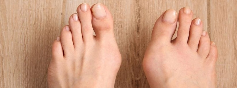 Haglund Deformitesi Topuk Arkasındaki Ağrılı Çıkıntı ve Tedavi Seçenekleri